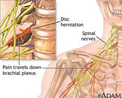 neck pain 2