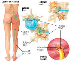 sciatica2