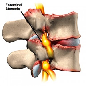 sciatica3