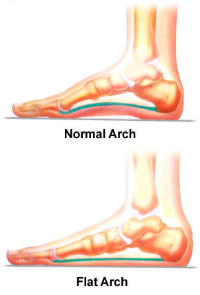 pes planus treatment