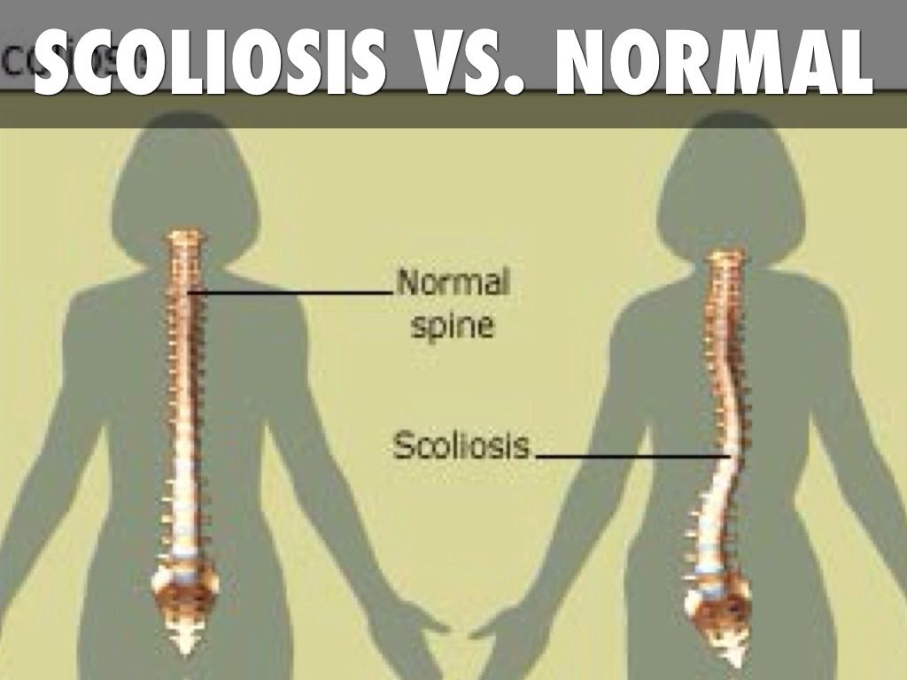 scoliosis