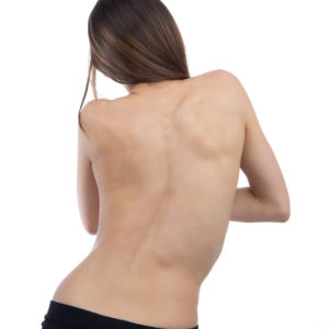 scoliosis1