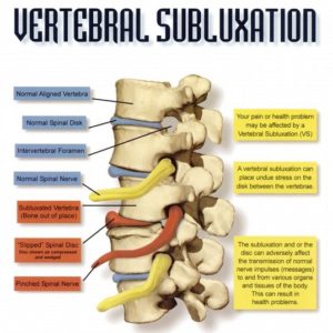 vertebral-subluxation
