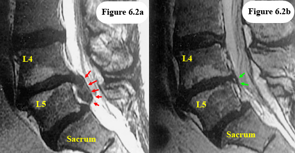 HNP-resorption