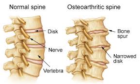 arthritis12