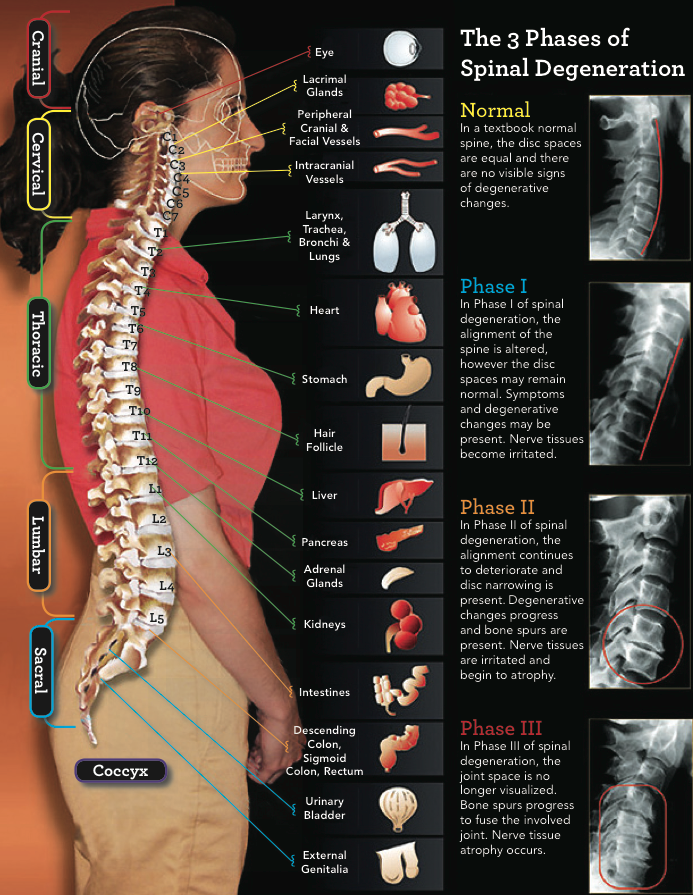 sublaxation-degeneration